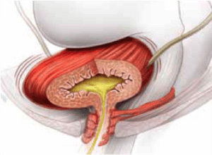Bladder | Urinary Incontinence